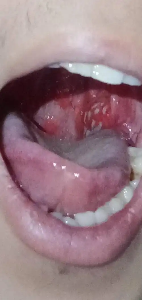 口腔里面红肿,有白点.很痛,口水很多.全身无力,手脚酸痛.