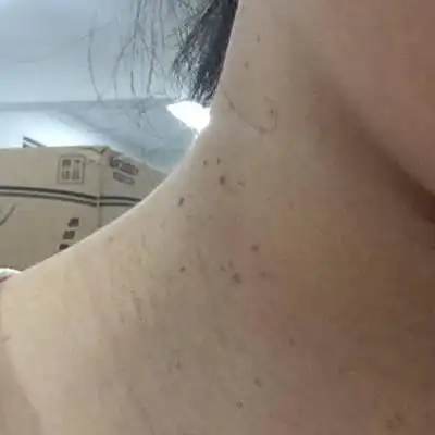 大家有和我一样脖子长了这种一粒粒的吗?跟怀孕有没有关系,要不要治疗