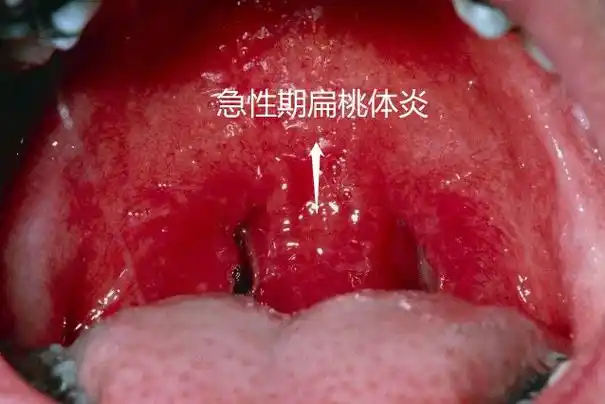 全身酸痛等症状,咽部疼痛,吞咽时明显,严重者疼痛可放射至耳部,扁桃体
